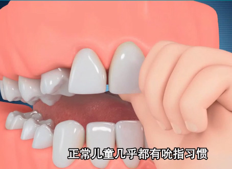 兒童不良習慣吸吮手指