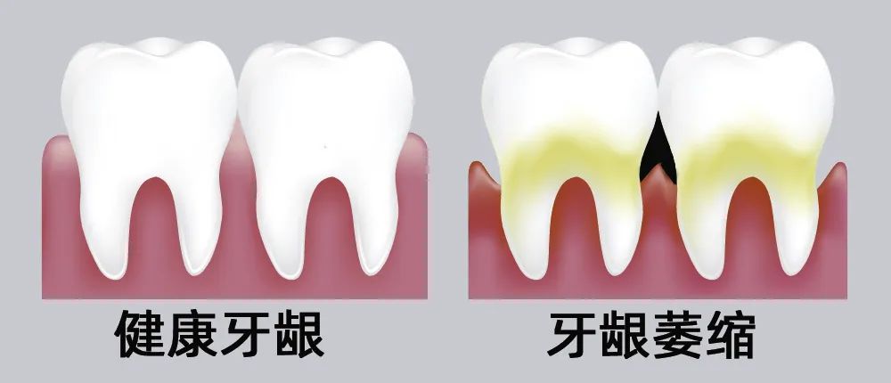 牙縫大露出“黑三角”，既塞牙又難看！還能恢復(fù)嗎？